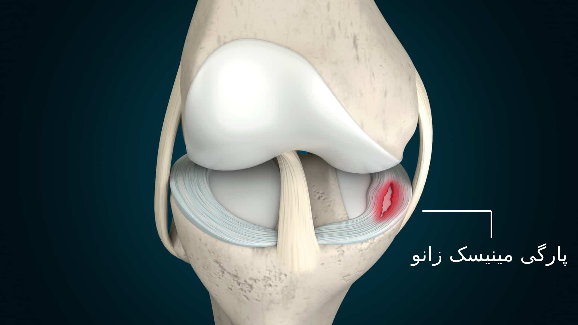 بهترین روش های درمان پارگی مینیسک زانو - اورتینو