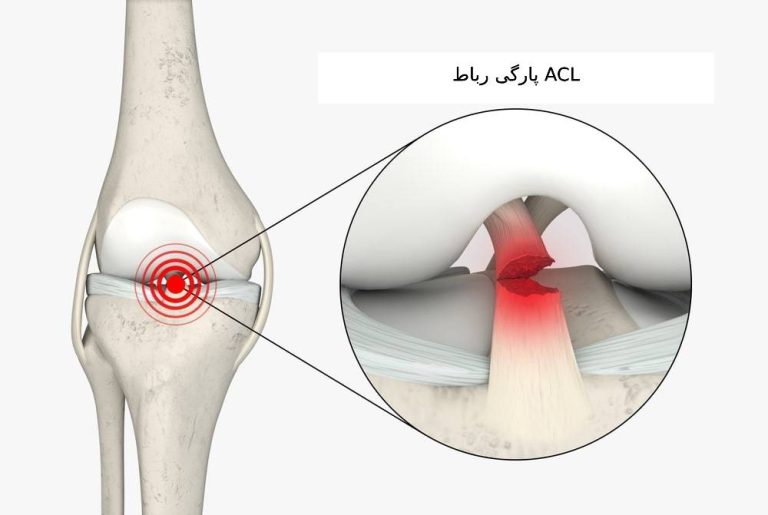 پارگی رباط ACL