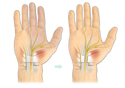 سندرم تونل کارپال