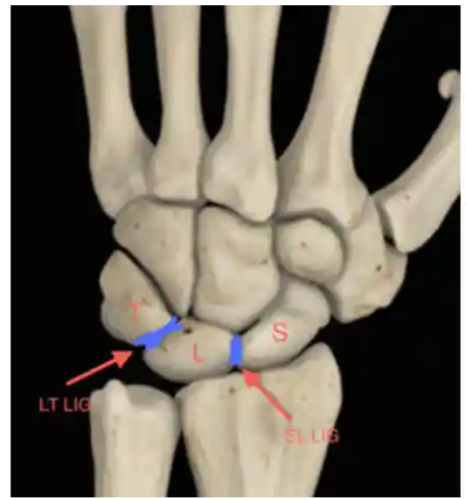 در رفتگی استخوان هلالی( lunate) مچ دست