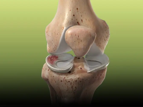 علائم پارگی مینیسک