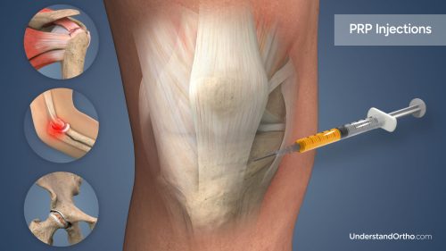 تزریق PRP